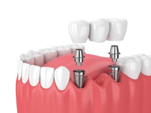 Dental Implant Bridge