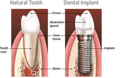 Implant Diagram