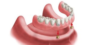 Implant Overdentures